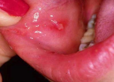 علائم آفت دهان چیست؟